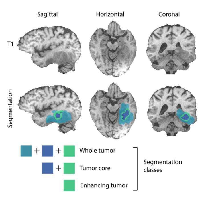Tumor segmentation